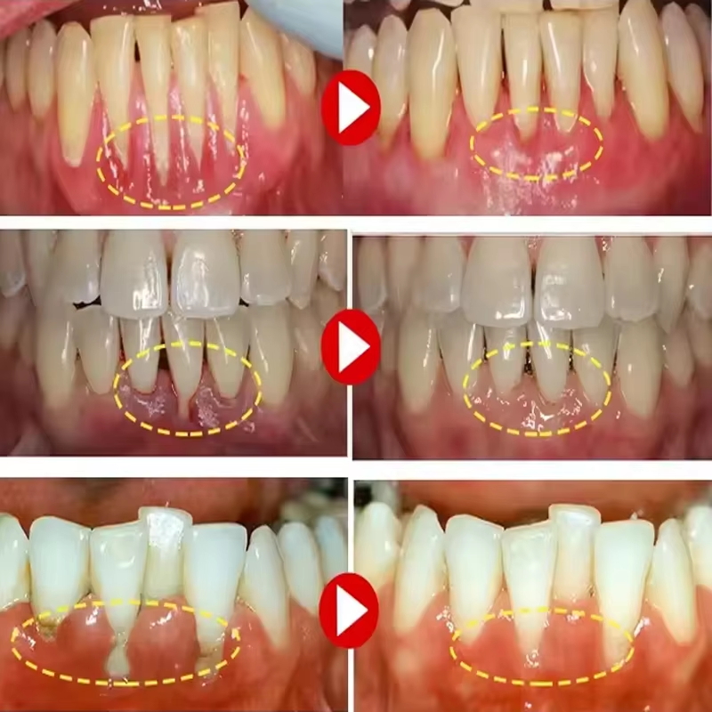 Gel blanchissant pour les dent - Teeth Whitening Gel avis et prix